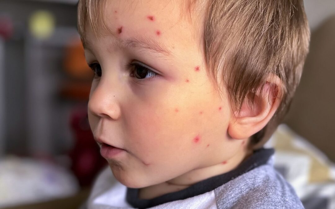 Why the good news about the mpox outbreak of 2025 isn’t really good after all